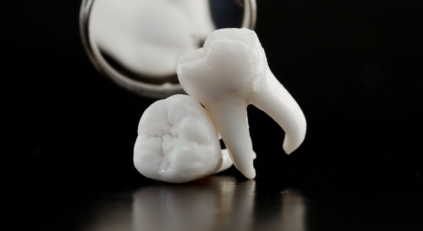 wisdom-teeth-extraction-brush-n-floss-dental-victoria-australia